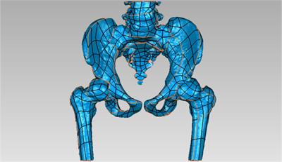 Computer-assisted design model to evaluate the outcome of combined osteotomies in Legg-Calvé-Perthes disease